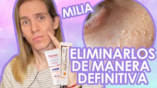 TRATAMIENTO de QUISTES DE MILLIUM o MILIA ¿Cómo eliminarlos Tratamiento Dermatologico [upl. by Armillas]