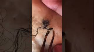 Removal of ingrown hair [upl. by Eleanore]