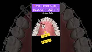 ORTHODONTICS Extrusion force Braces [upl. by Ycak]