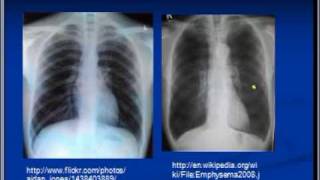 Chest xray interpretation COPD and Emphysema [upl. by Laine887]