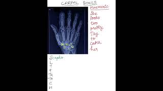 CARPAL BONES  The Most Common amp Famous Mnemonic in MBBS life anatomy mbbs medico neetpg usmle [upl. by Holsworth]