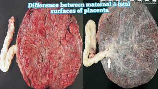 Difference between maternal amp fetal surfaces of placenta in hindihow to identify them placenta [upl. by Georgianne]