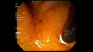 Treatment of neoplastic afferent limb syndrome by endoscopic gastrojejunostomy with a LAMS [upl. by Ayit]