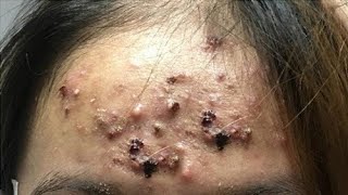 Big Cystic Acne Blackheads Extraction Blackheads amp Milia Whiteheads Removal Pimple Popping [upl. by Zoba]