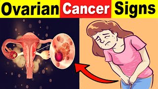 9 Common Ovarian Cancer Signs That You Should Never Ignore [upl. by Navannod]