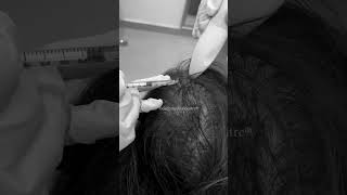 The Ultimate Solution For Hair Regrowth  Hair Transplant Clinic  Dadu Medical Centre [upl. by Sloan]