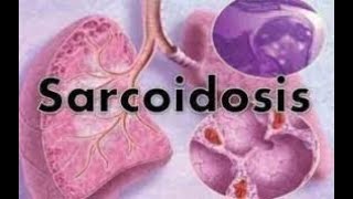 Sarcoidosis  sarcoidosis lung disease  sarcoidosis treatment  sarcoidosis radiology  symptoms [upl. by Gilly814]