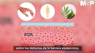 ¿Qué es la dermatitis atópica [upl. by Dorey]