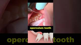 Operculum tooth treatment dentist dentistry wisdomtooth [upl. by Etep424]