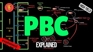 PRIMARY BILIARY CHOLANGITIS Pathogenesis Symptoms Diagnostic criteria PBC Treatment CIRRHOSIS [upl. by Luis629]