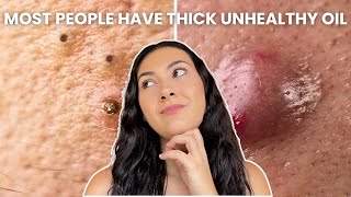 How To Treat Every Type of Acne Comedones Nodules Cysts [upl. by Nate]