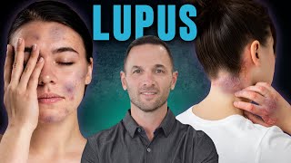 ¿Morados en la piel ATENCIÓN 🚨 Son SINTOMAS de LUPUS [upl. by Aisel168]