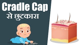 सिर पर पपड़ी का कारण और खुजली का इलाज  Cradle cap causes and treatment of scab on head in hindi [upl. by Getter]