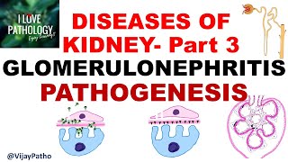 RENAL PATHOLOGY Part 3  Glomerulonephritis PATHOGENESIS [upl. by Nie]