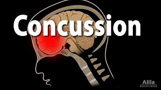 Concussion Pathophysiology Causes Symptoms and Treatment Animation [upl. by Brynna]