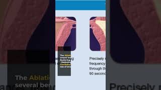 Painless Pulmonary Vein Isolation Your Ultimate Guide to Atrial Fibrillation Ablation [upl. by Aniras]