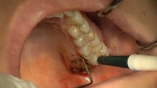 Palatal Fibrous Hyperplasia Excision [upl. by Emina]