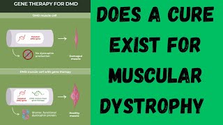 Does a cure exist for muscular dystrophy [upl. by Ecinahs]