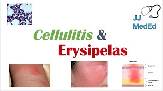 Cellulitis vs Erysipelas  Bacterial Causes Risk Factors Signs and Symptoms Treatment [upl. by Brendis]