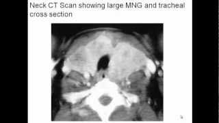 Multinodular Goiter Evaluation and Management [upl. by Willms]