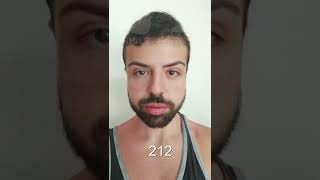 Hair Transplant Time Lapse  Day 1 to Day 347  1 Year Result [upl. by Anitsirc]