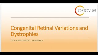 OCT Interpretation Session 7 Congenital Retinal Variations and Dystrophies [upl. by Wini338]