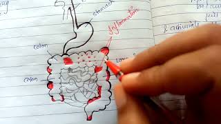 pathogenesis of inflammatory bowel disease NGMedicals [upl. by Aseefan]