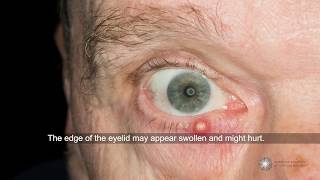 Are styes contagious and what can I do about them  Ask an Ophthalmologist [upl. by Nahgaem254]