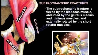 Femur fracture Subtrochanteric fracture  Everything You Need To Know  Dr Nabil Ebraheim [upl. by Accalia755]