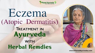 Eczema Atopic Dermatitis Treatment in Ayurveda with Herbal Remedies [upl. by Arrimat]