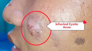 Incision and Drainage of Infected Cystic Acne StepbyStep Guide [upl. by Dermot]