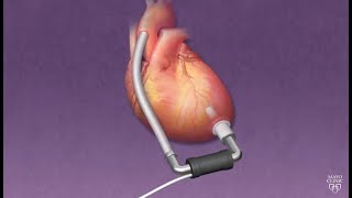 Mayo Clinic Minute How ventricular assist devices can help heart patients [upl. by Medeah]