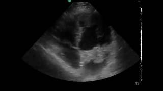 Atrial Myxoma Ultrasound JETem [upl. by Ahterahs712]