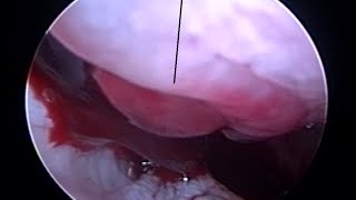 Cause amp Site of Epistaxis Diagnosed on Nose Endoscopy [upl. by Nnav]