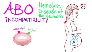 ABO Incompatibility  Hemolytic Disease Of The Newborn HDN  Hematology amp Pathology [upl. by Iredale201]