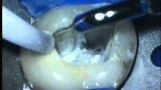 V1331  Nonsurgical Retreatment Disassembly amp Missed Canals Quality amp Profitability [upl. by Bogart]