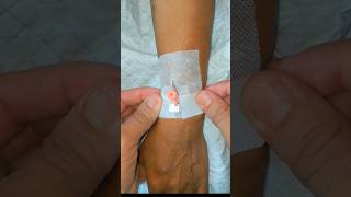 IV Cannulation subscribe cannula ivcannula health shortsindia [upl. by Odnesor]