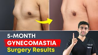 Grade 2 Gynecomastia Surgery CloseUp of Scar amp Results  5Month Before amp After  Dr Dhruv  Pune [upl. by Elegna]