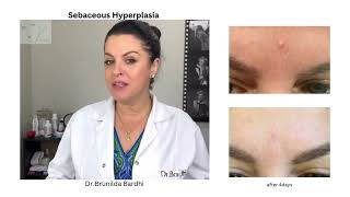 Sebaceous Hyperplasia Botox treatment DrBrunilda Bardhi [upl. by Krid]