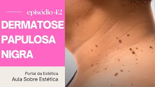 Entendendo Sobre Dermatose Papulosa Nigra e Seu Tratamento [upl. by Yltneb]