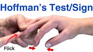 How to Perform a Hoffmans Test  Inverted Supinator Sign  Clonus  Hyperreflexia [upl. by Tenaj]