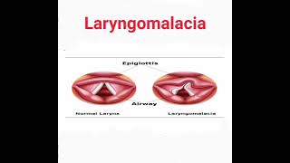 Laryngomalacia mrcpch Recall Communication [upl. by Atinhoj]