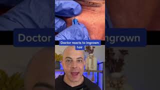 Doctor reacts to ingrown hair removal ingrownhair dermreacts doctorreacts [upl. by Huntingdon]