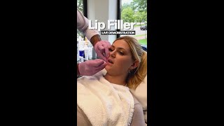 Lip Filler Live Demo ✨ [upl. by Yi]