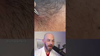 Derm reacts to BIG ingrown hair dermreacts doctorreacts ingrownhair [upl. by Eseneg]