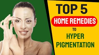 Top 5 Home Remedies To Reduce Hyper Pigmentation [upl. by Eirrehc]