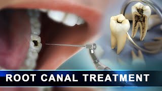 Root Canal Treatment step by step  Curveia Dental Animation in 3D  Endodontics for tooth decay [upl. by Etteval764]