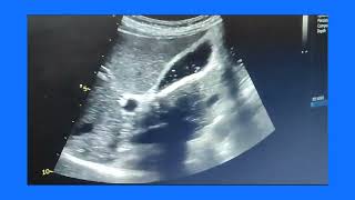 Empyema gallbladder or pyocele or suppurative cholecystitis ultrasound and color Doppler video [upl. by Huldah]