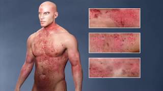 Atopic Dermatitis eczema From the Inside Out [upl. by Nahsez]