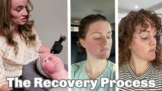 Morpheus8 Laser  Treatment Recovery amp Review [upl. by Arianna]